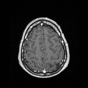 File:Central-variant posterior reversible encephalopathy syndrome (PRES) (Radiopaedia 43880-47358 Axial T1 C+ 140).jpg