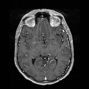File:Central-variant posterior reversible encephalopathy syndrome (PRES) (Radiopaedia 43880-47358 Axial T1 C+ 72).jpg