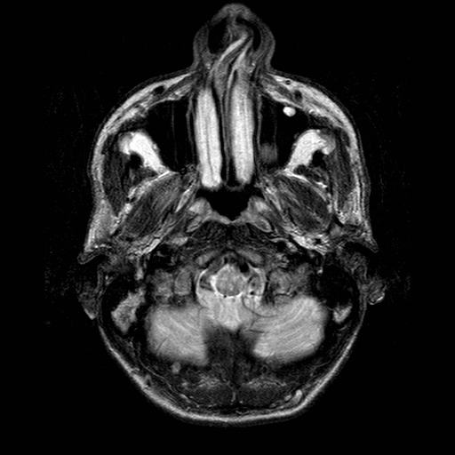 File:Central-variant posterior reversible encephalopathy syndrome (PRES) (Radiopaedia 43880-47358 Axial T2 1).jpg
