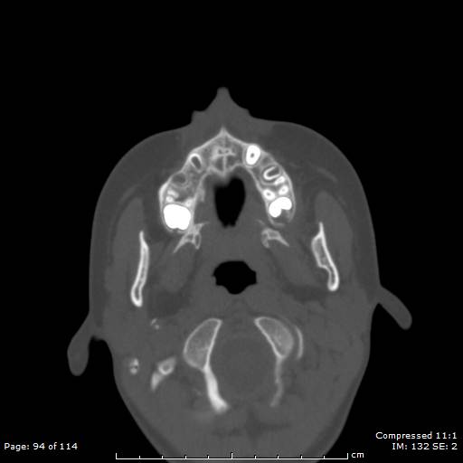 File:Central giant cell granuloma (Radiopaedia 45612-49754 Axial bone window 47).jpg