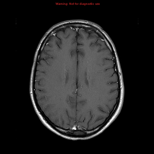 File:Central nervous system vasculitis (Radiopaedia 8410-9235 Axial T1 C+ 16).jpg