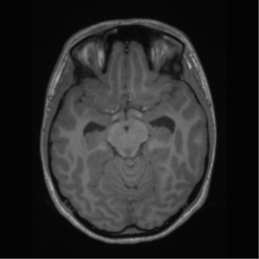 File:Central neurocytoma (Radiopaedia 37664-39557 Axial T1 28).png