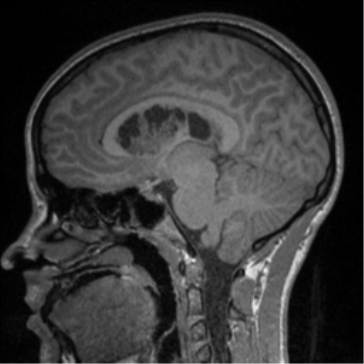 Central neurocytoma (Radiopaedia 37664-39557 Sagittal T1 53).png
