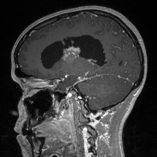 File:Central neurocytoma (Radiopaedia 37664-39557 Sagittal T1 C+ 40).png