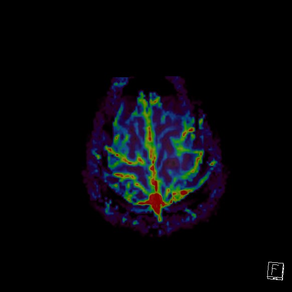 Central neurocytoma (Radiopaedia 84497-99872 Axial Perfusion 28).jpg