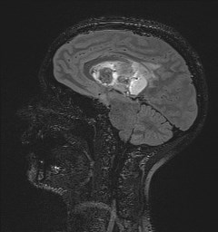File:Central neurocytoma (Radiopaedia 84497-99872 Sagittal Flair + Gd 72).jpg