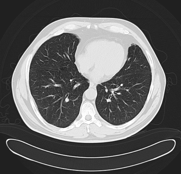 Centrilobular pulmonary emphysema (Radiopaedia 26808-26971 C 30).jpg