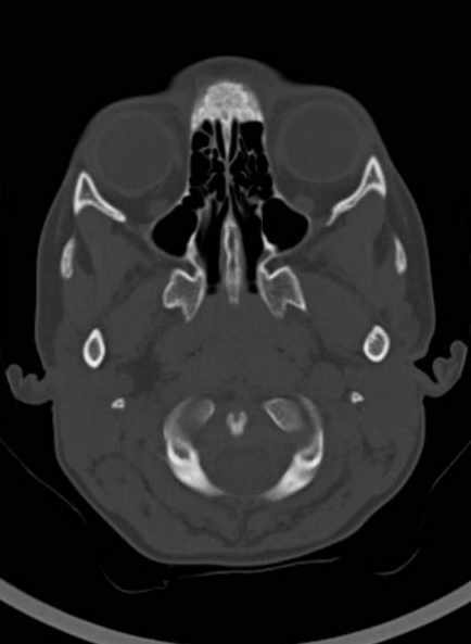 Cerebellar abscess (Radiopaedia 73727-84527 Axial bone window 18).jpg