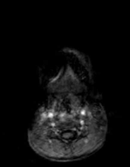 Cerebellar abscess (Radiopaedia 73727-84563 Axial T1 C+ fat sat 1).jpg