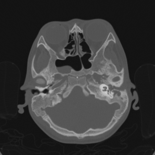 File:Cerebellar abscess secondary to mastoiditis (Radiopaedia 26284-26413 Axial bone window 45).jpg