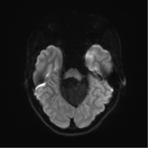Cerebellar agenesis with hypoplastic pons (pontocerebellar hypoplasia) (Radiopaedia 57224-64138 Axial DWI 49).png