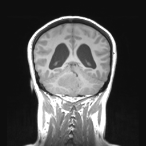 Cerebellar ependymoma complicated by post-operative subdural hematoma (Radiopaedia 83322-97736 Coronal T1 39).png