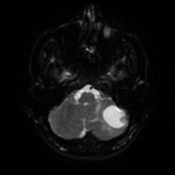 Cerebellar hemangioblastoma (Radiopaedia 29570-30077 Axial DWI 32).jpg