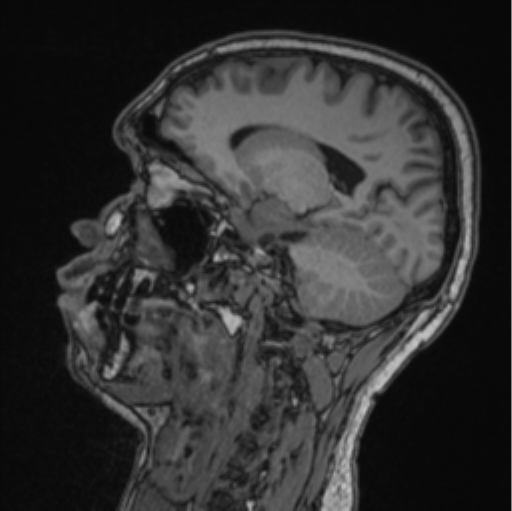 Cerebellar hemangioblastomas and pituitary adenoma (Radiopaedia 85490-101176 Sagittal T1 45).png