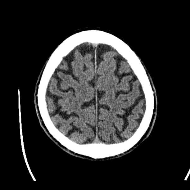 Cerebellar hemorrhage (Radiopaedia 27193-27359 Axial non-contrast 44).jpg