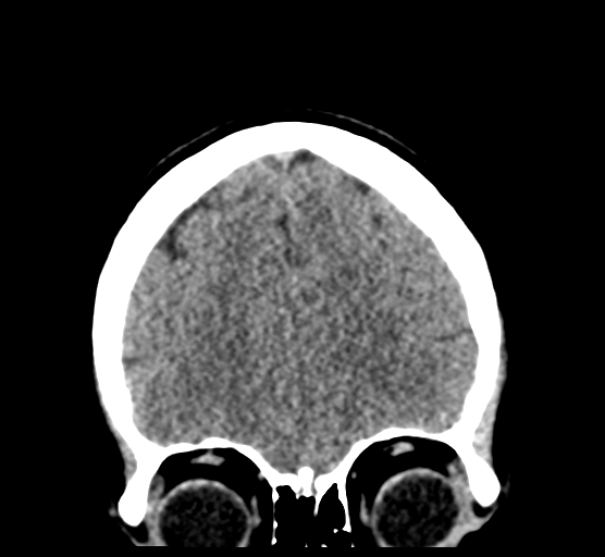 Cerebellar metastases - colorectal adenocarcinoma (Radiopaedia 40947-43652 Coronal non-contrast 25).png