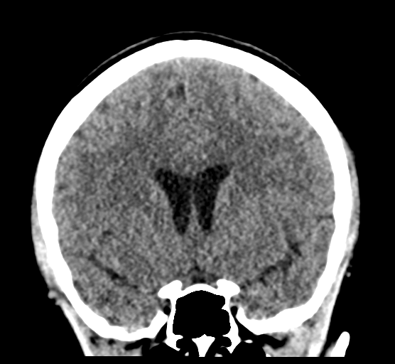 Cerebellar metastases - colorectal adenocarcinoma (Radiopaedia 40947-43652 Coronal non-contrast 41).png
