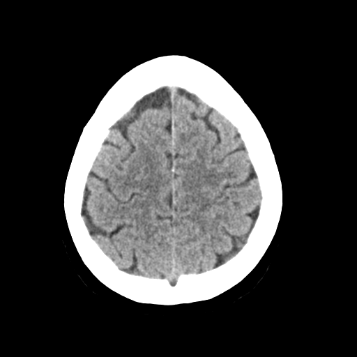 Cerebellar metastasis (Radiopaedia 54578-60812 Axial non-contrast 41).png