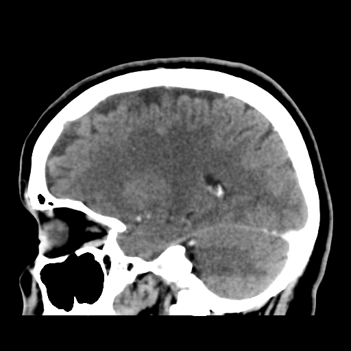 File:Cerebellar metastasis (cystic appearance) (Radiopaedia 41395-44258 F 20).png