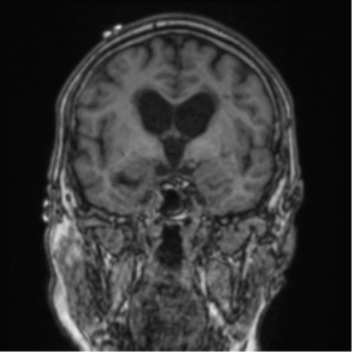 Cerebellar metastasis from lung adenocarcinoma (Radiopaedia 86690-102829 Coronal T1 59).png