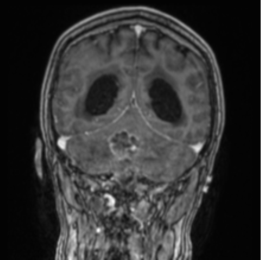 Cerebellar metastasis from lung adenocarcinoma (Radiopaedia 86690-102829 Coronal T1 C+ 33).png