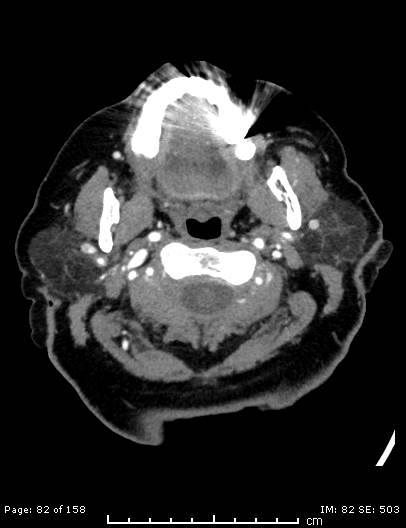 Cerebellar strokes due to intracranial giant cell arteritis (Radiopaedia 68799-78510 CT angiogram 82).jpg