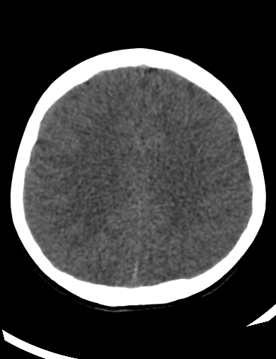 File:Cerebellitis (Radiopaedia 63148-71665 Axial non-contrast 18).jpg