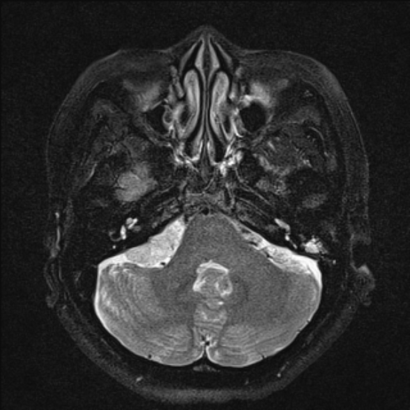 File:Cerebellopontine angle meningioma (Radiopaedia 53561-59591 Axial T2 fat sat 10).jpg