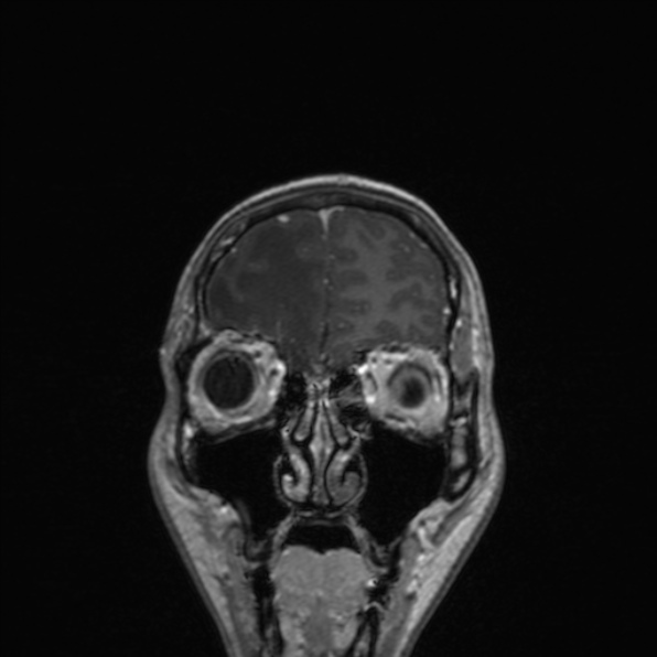 Cerebral abscess (Radiopaedia 24212-24478 Coronal T1 C+ 48).jpg