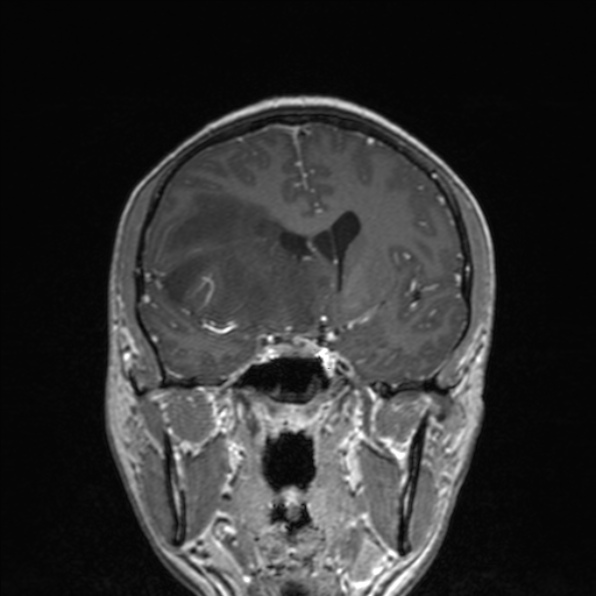 Cerebral abscess (Radiopaedia 24212-24478 Coronal T1 C+ 96).jpg