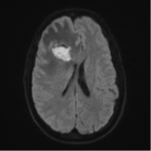 File:Cerebral abscess (Radiopaedia 60342-68009 Axial DWI 58).png