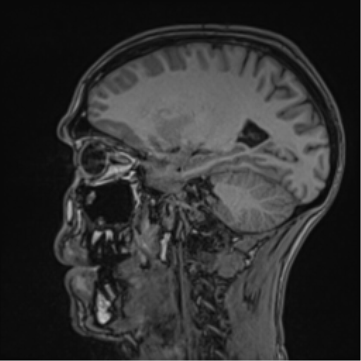 File:Cerebral abscess (Radiopaedia 60342-68009 Sagittal T1 22).png