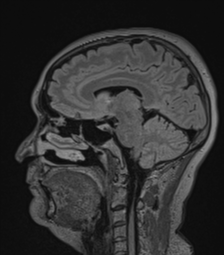 Cerebral abscess from pulmonary arteriovenous malformation (Radiopaedia 86275-102291 Sagittal FLAIR 34).png