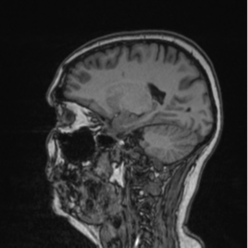 Cerebral abscess from pulmonary arteriovenous malformation (Radiopaedia 86275-102291 Sagittal T1 43).png