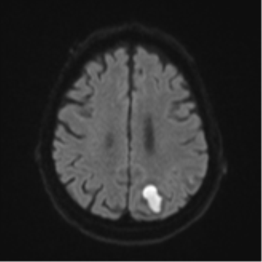 Cerebral abscesses- medically managed (Radiopaedia 45183-49179 Axial DWI 48).png