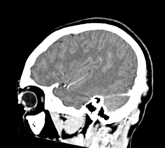 File:Cerebral abscesses (Radiopaedia 70458-80568 Sagittal Contrast 42).jpg