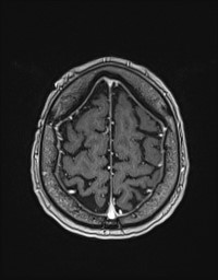 Cerebral amyloid angiopathy-related inflammation (Radiopaedia 58270-65377 Axial T1 C+ fat sat 127).jpg