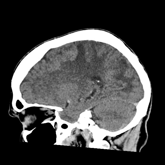 Cerebral amyloid angiopathy-related inflammation (Radiopaedia 74836-85848 C 22).jpg