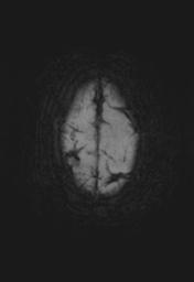 File:Cerebral amyloid angiopathy (Radiopaedia 29129-29518 Axial SWI MIP 28).jpg