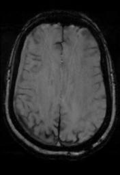 File:Cerebral amyloid angiopathy (Radiopaedia 29129-29518 Axial SWI Magnitude 24).jpg