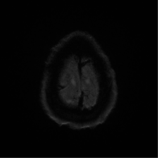 Cerebral amyloid angiopathy (Radiopaedia 46082-50433 Axial DWI 53).png