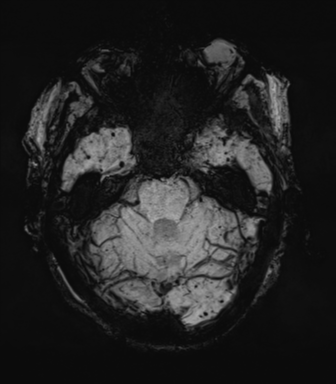 Cerebral amyloid angiopathy (Radiopaedia 46082-50433 Axial SWI MIP 20).png