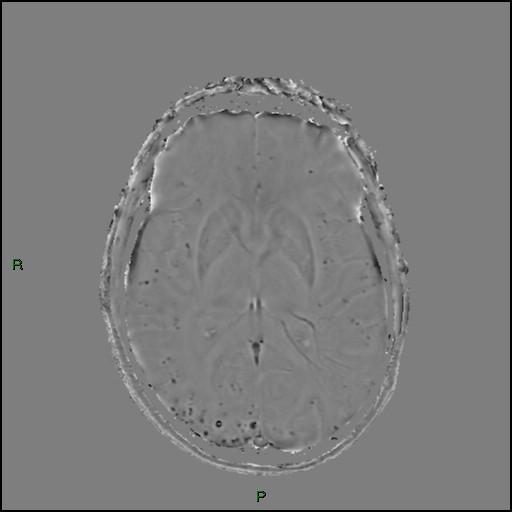 Cerebral amyloid angiopathy (Radiopaedia 77506-89664 H 54).jpg