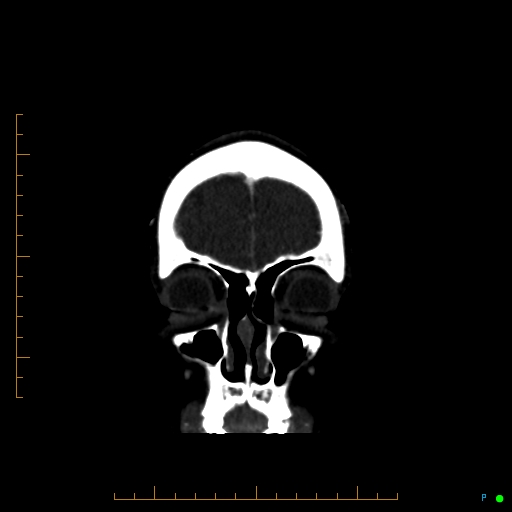 Cerebral arteriovenous malformation (AVM) (Radiopaedia 78162-90706 Coronal CTA 89).jpg