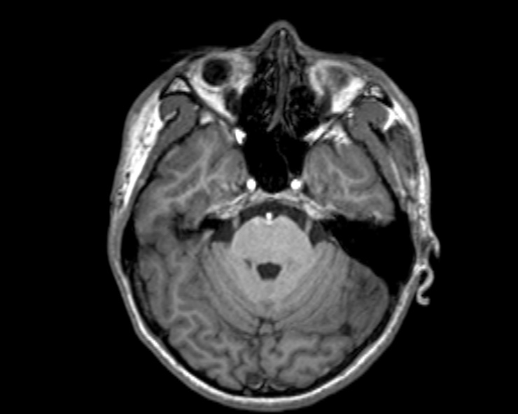 Cerebral arteriovenous malformation (Radiopaedia 30198-30813 Axial T1 42).jpg