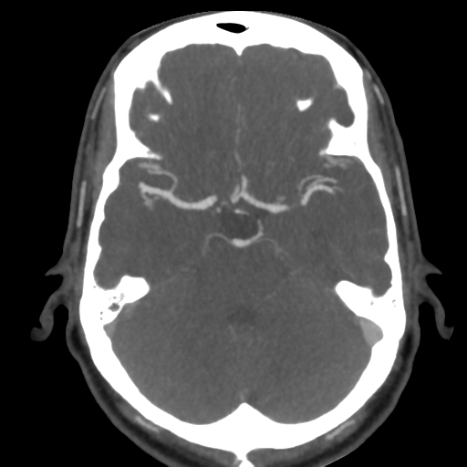 Cerebral arteriovenous malformation (Radiopaedia 39259-41505 AX CEREBRAL CTA 19).png