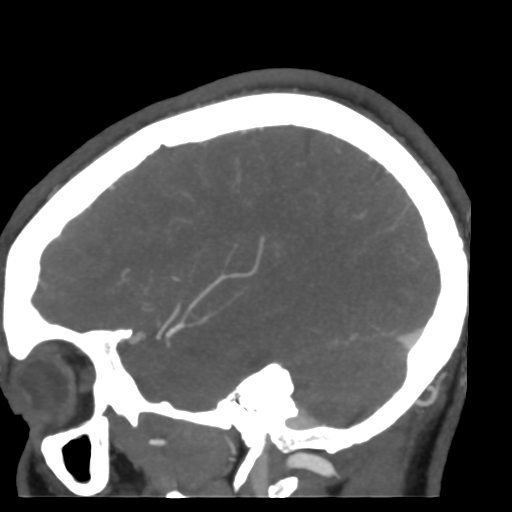 File:Cerebral arteriovenous malformation (Radiopaedia 39259-41505 Sagittal 46).png
