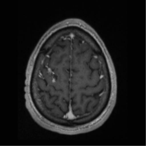 File:Cerebral arteriovenous malformation (Radiopaedia 55798-62372 Axial T1 C+ 65).png