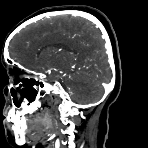 File:Cerebral arteriovenous malformation (Radiopaedia 73830-84645 Sagittal C+ delayed 37).jpg