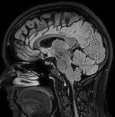 Cerebral arteriovenous malformation (Radiopaedia 74411-85654 Sagittal FLAIR 57).jpg